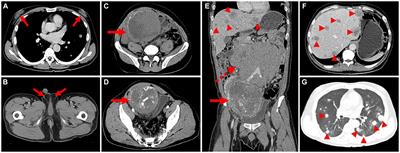 A poor prognostic male choriocarcinoma with multiple systemic metastases: a case report and the literature review